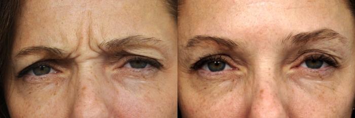 Before & After BOTOX® Cosmetic Case 85 View #1 View in New York, NY