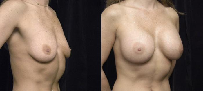 Before & After Breast Augmentation Case 138 View #2 View in New York, NY