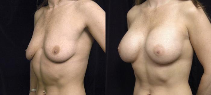 Before & After Breast Augmentation Case 138 View #3 View in New York, NY