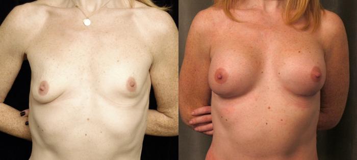 Before & After Breast Augmentation Case 139 View #1 View in New York, NY