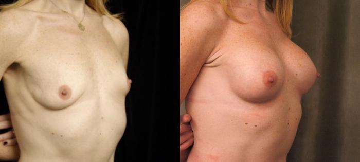 Before & After Breast Augmentation Case 139 View #2 View in New York, NY