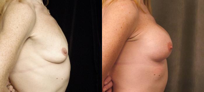 Before & After Breast Augmentation Case 139 View #3 View in New York, NY