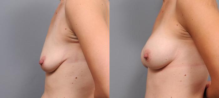 Before & After Breast Augmentation Case 141 View #3 View in New York, NY