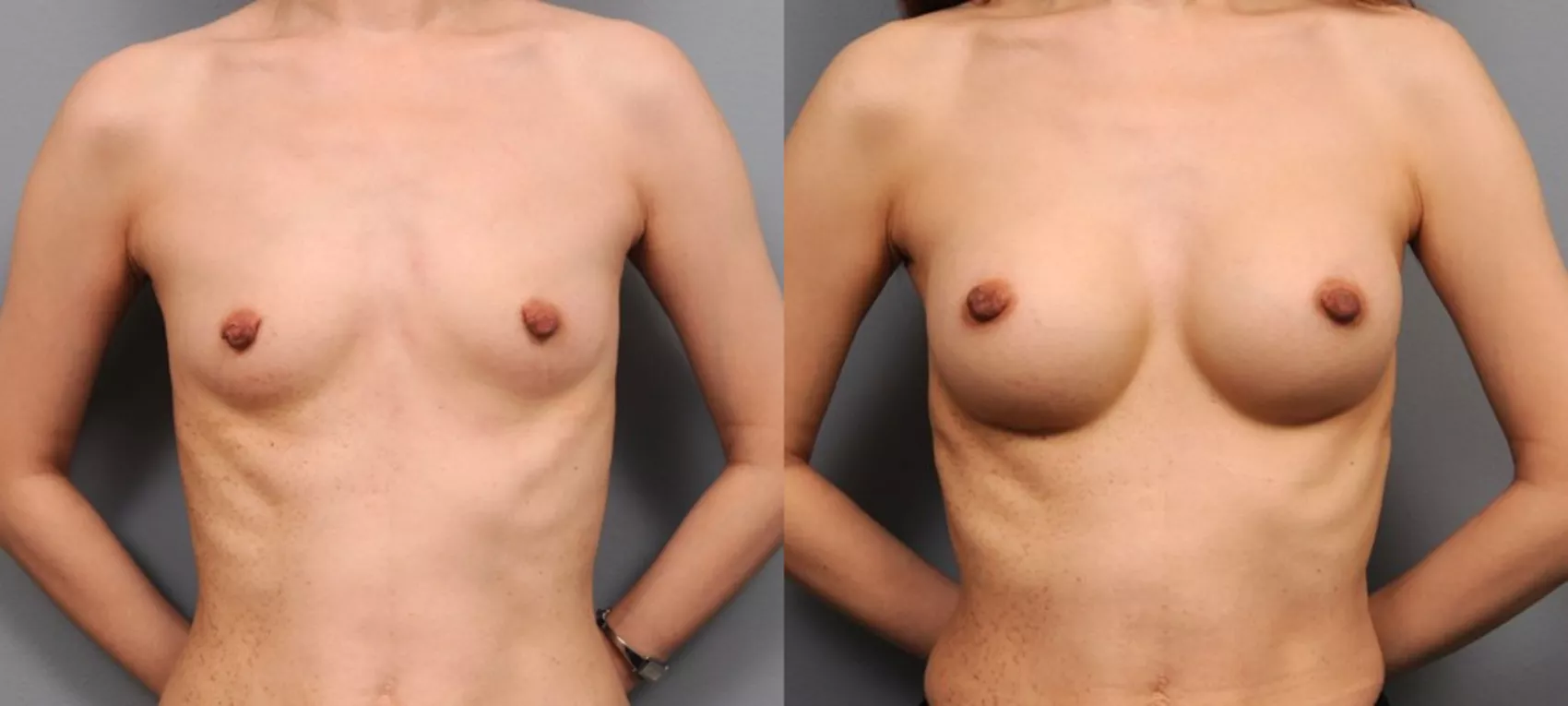 Breast Augmentation Before and After Photos