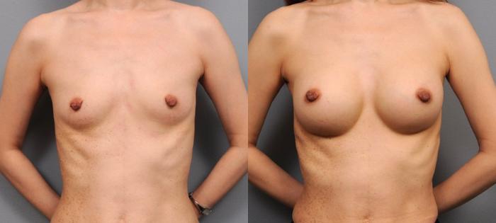 Before & After Breast Augmentation Case 142 View #1 View in New York, NY