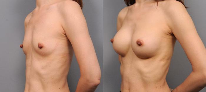 Before & After Breast Augmentation Case 142 View #2 View in New York, NY