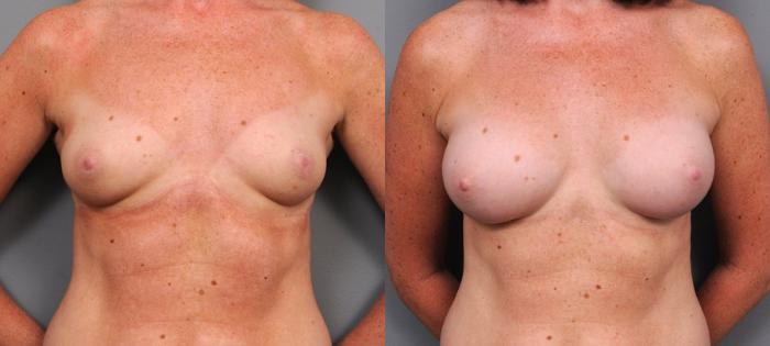 Before & After Breast Augmentation Case 143 View #1 View in New York, NY