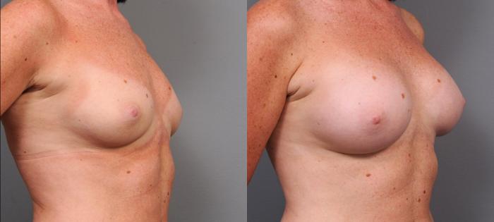 Before & After Breast Augmentation Case 143 View #2 View in New York, NY