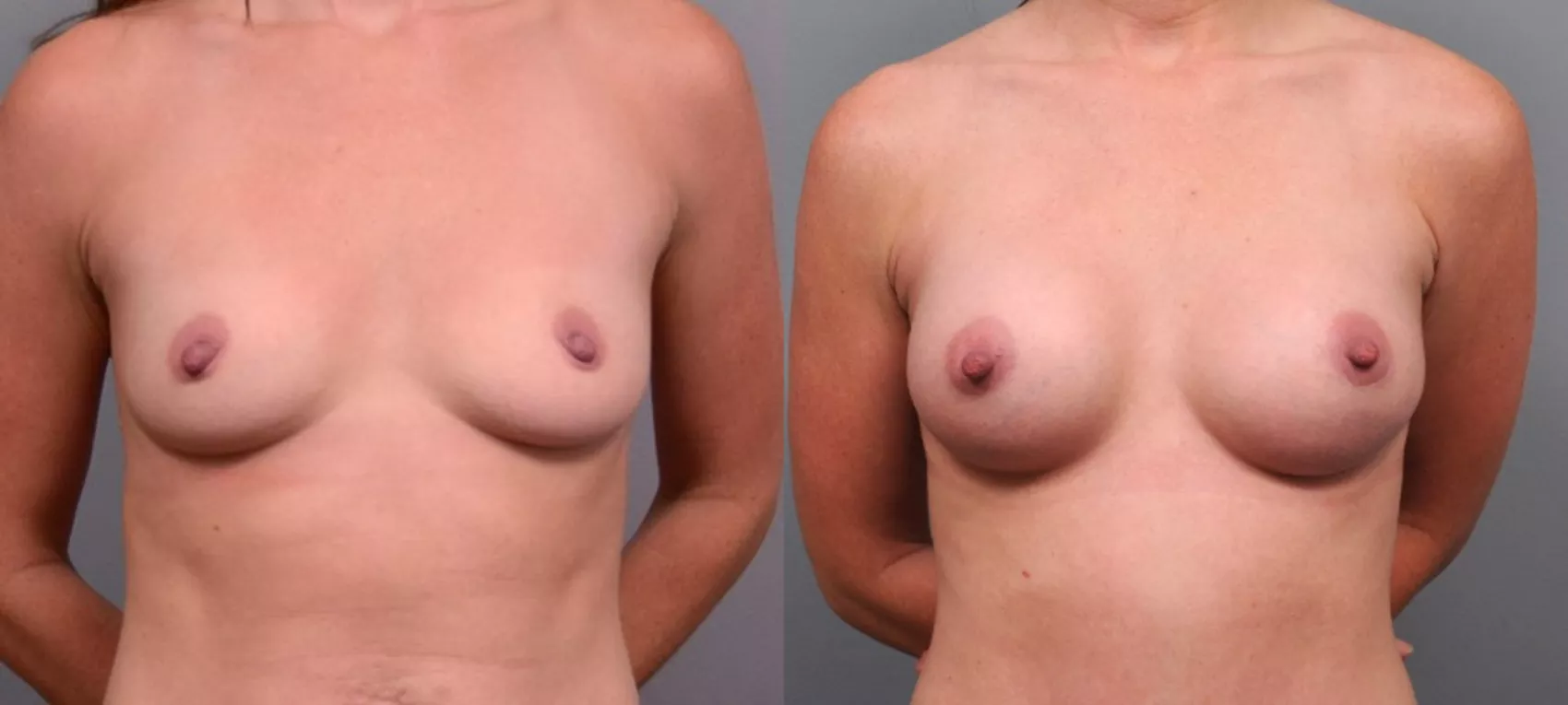 Breast Augmentation Before and After Photos