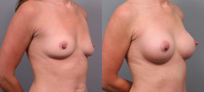 Before & After Breast Augmentation Case 144 View #2 View in New York, NY