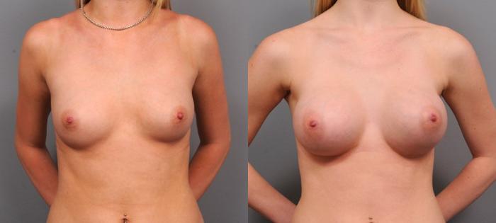 Before & After Breast Augmentation Case 145 View #1 View in New York, NY