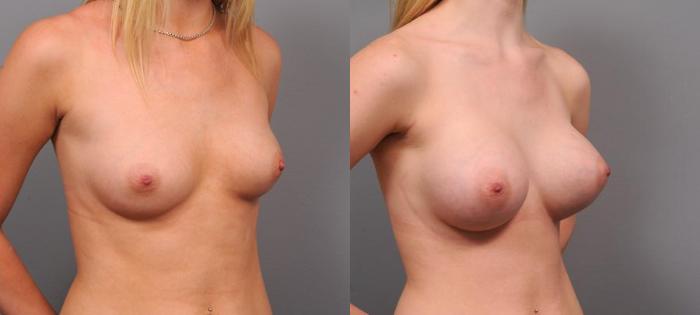 Before & After Breast Augmentation Case 145 View #2 View in New York, NY