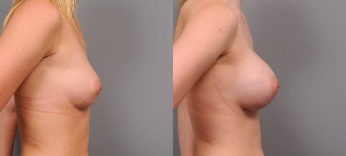 Before & After Breast Augmentation Case 145 View #3 View in New York, NY