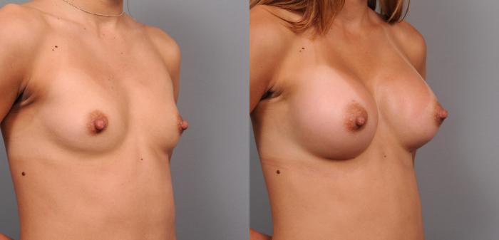 Before & After Breast Augmentation Case 152 View #2 View in New York, NY