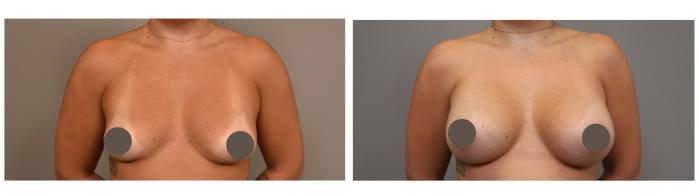 Breast Augmentation Results NYC