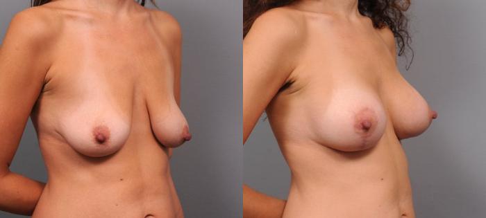 Before & After Breast Augmentation Case 100 View #2 View in New York, NY