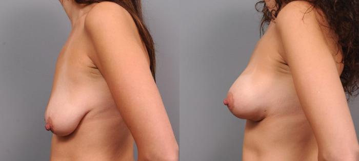 Before & After Breast Lift Case 100 View #3 View in New York, NY