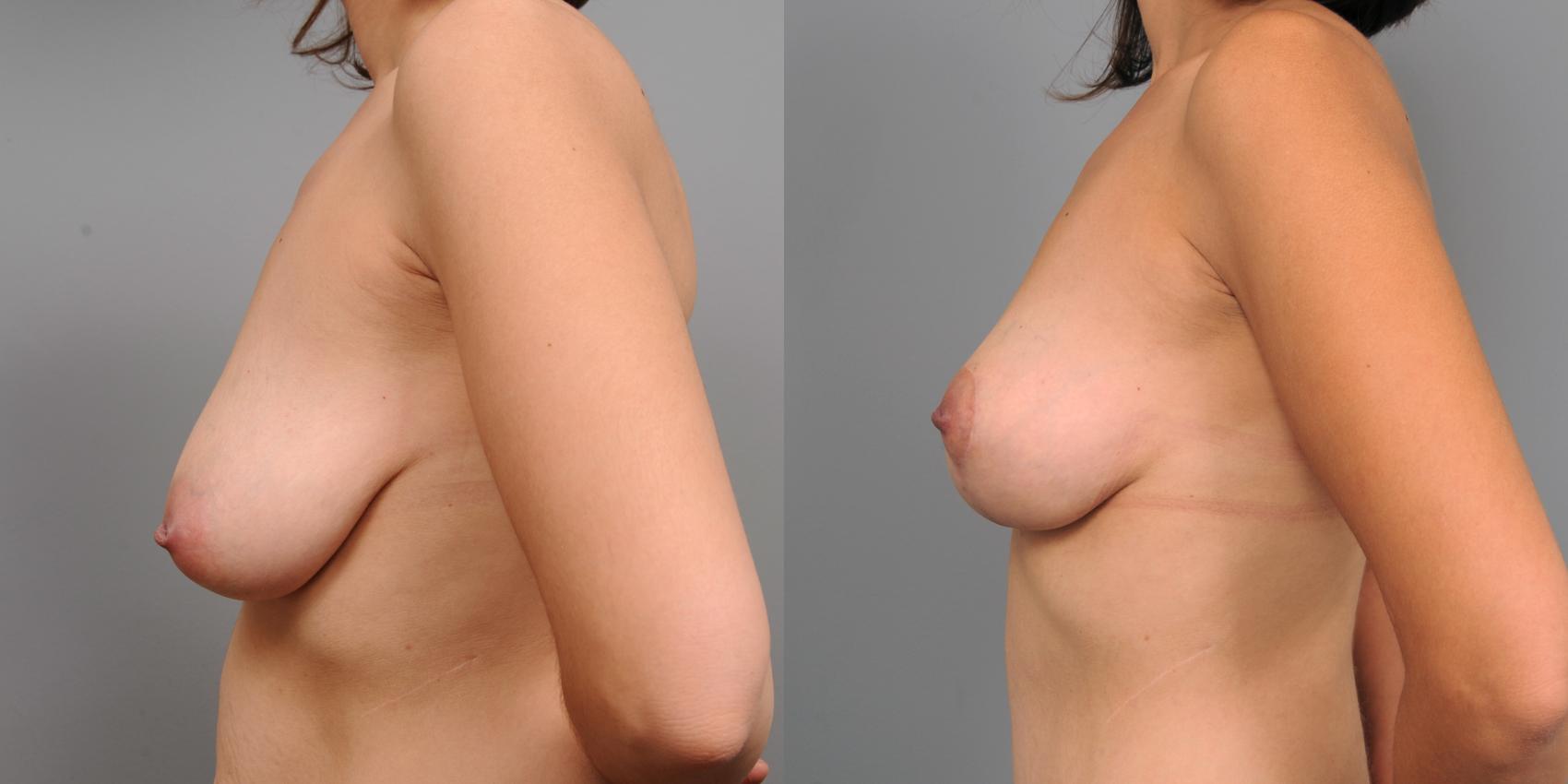 Before & After Breast Lift Case 197 View #1 View in New York, NY
