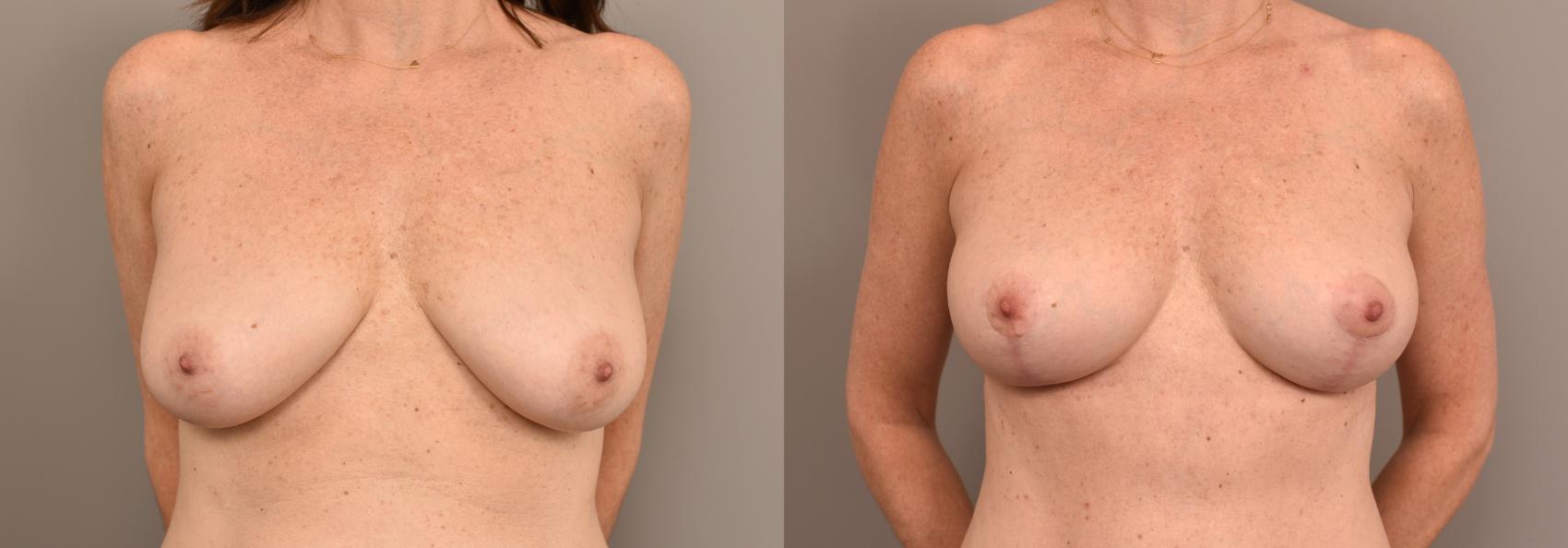Before & After Breast Lift Case 233 View #1 View in New York, NY