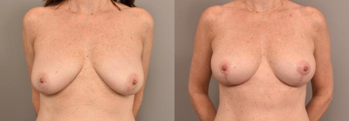 Before & After Breast Lift Case 233 View #1 View in New York, NY