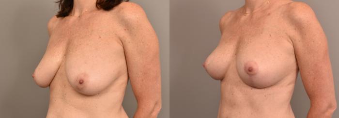 Before & After Breast Lift Case 233 View #2 View in New York, NY