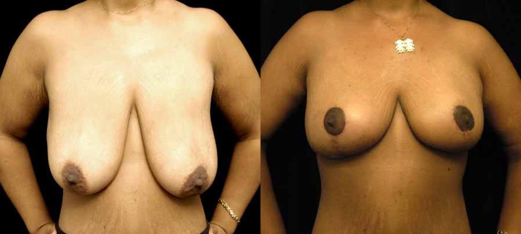 Before & After Breast Lift Case 90 View #1 View in New York, NY
