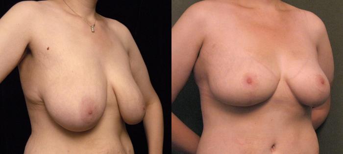 Before & After Breast Lift Case 91 View #2 View in New York, NY