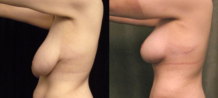 Before & After Breast Lift Case 91 View #3 View in New York, NY