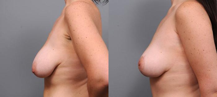 Before & After Breast Lift Case 93 View #1 View in New York, NY
