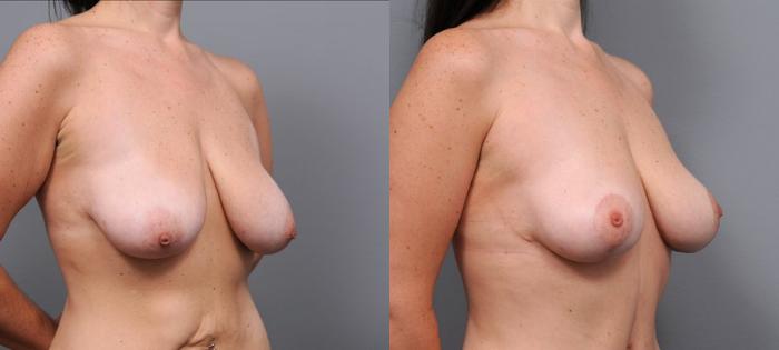 Before & After Breast Lift Case 93 View #3 View in New York, NY