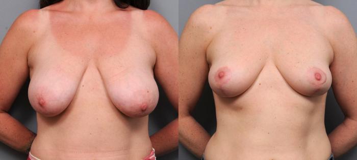 Before & After Breast Lift Case 94 View #1 View in New York, NY
