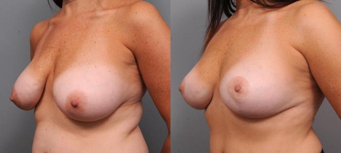 Before & After Breast Lift Case 95 View #1 View in New York, NY