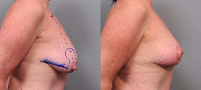 Before & After Breast Lift Case 96 View #1 View in New York, NY
