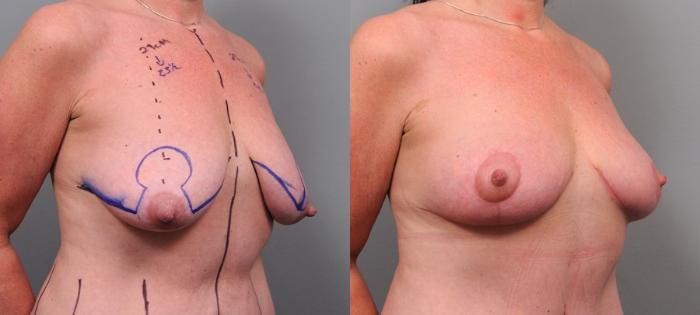 Before & After Breast Lift Case 96 View #2 View in New York, NY