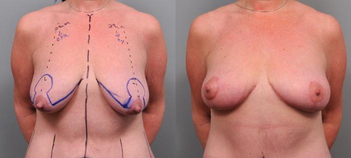 Before & After Breast Lift Case 96 View #4 View in New York, NY