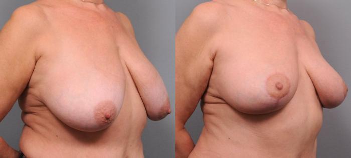 Before & After Breast Lift Case 97 View #2 View in New York, NY