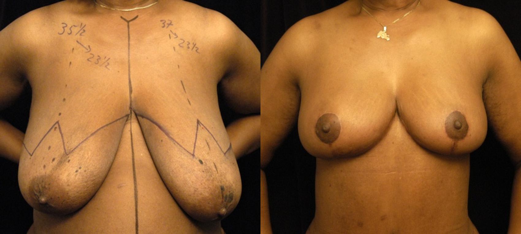 Before & After Breast Reduction Case 101 View #1 View in New York, NY