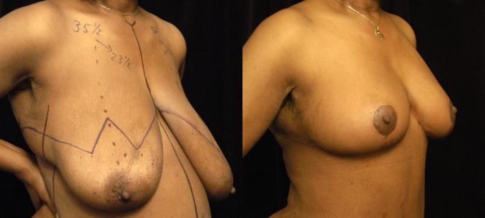Before & After Breast Reduction Case 101 View #2 View in New York, NY