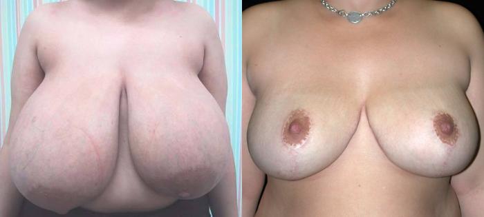 Before & After Breast Reduction Case 102 View #1 View in New York, NY
