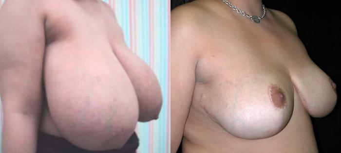 Before & After Breast Reduction Case 102 View #2 View in New York, NY