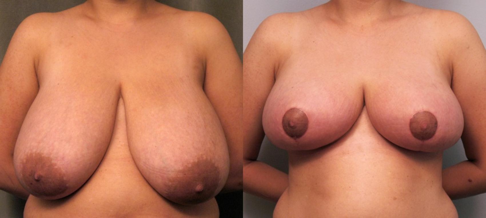 Before & After Breast Reduction Case 103 View #1 View in New York, NY