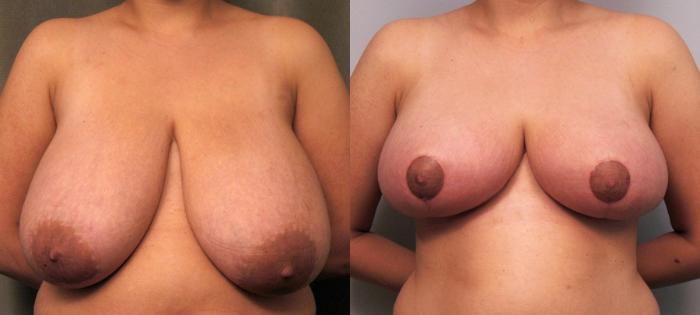 Before & After Breast Reduction Case 103 View #1 View in New York, NY