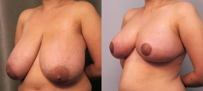 Before & After Breast Reduction Case 103 View #2 View in New York, NY
