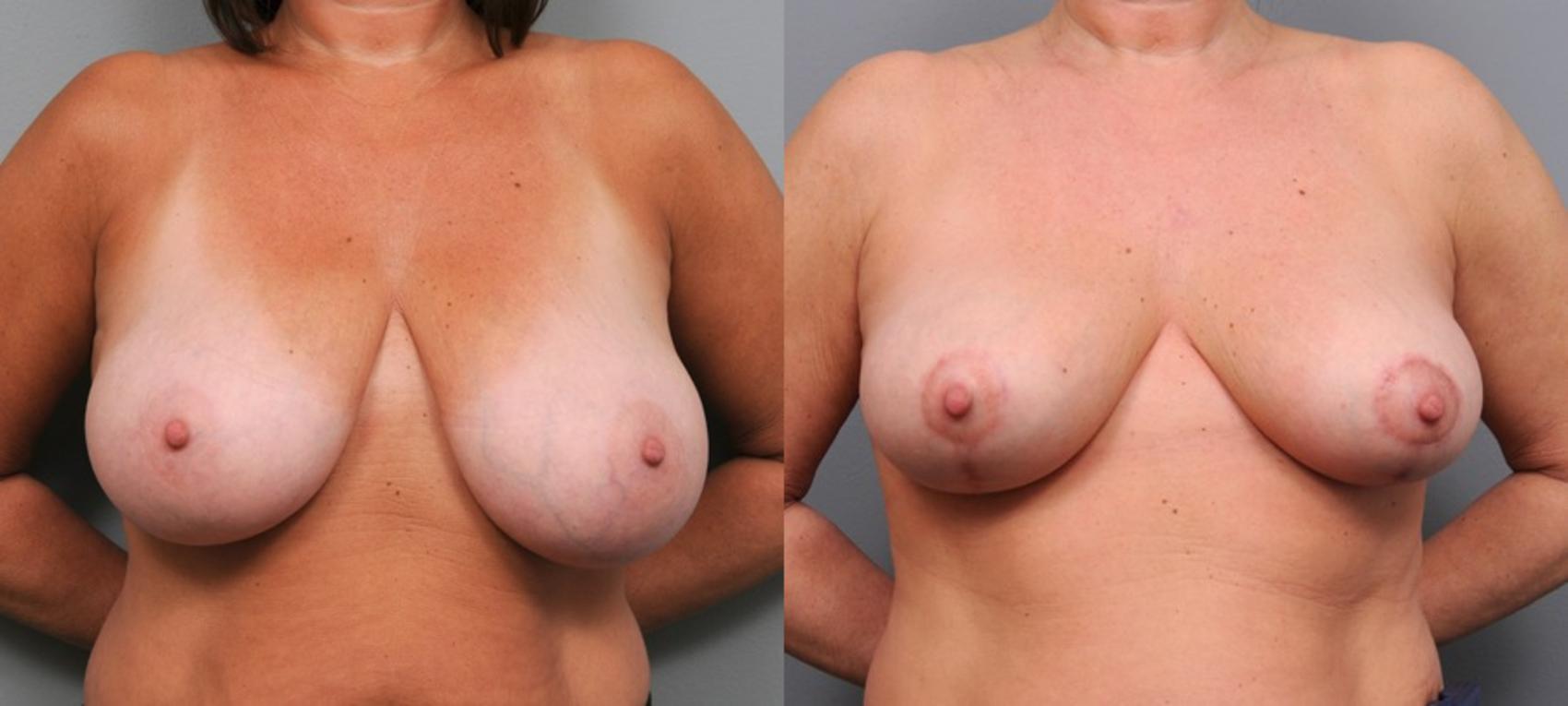 Before & After Breast Lift Case 105 View #1 View in New York, NY