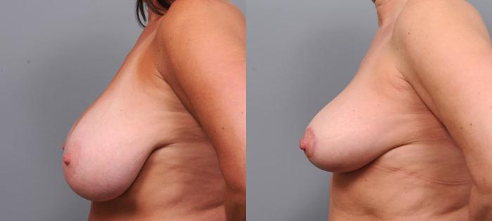 Before & After Breast Lift Case 105 View #2 View in New York, NY