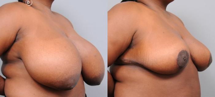 Before & After Breast Reduction Case 106 View #2 View in New York, NY