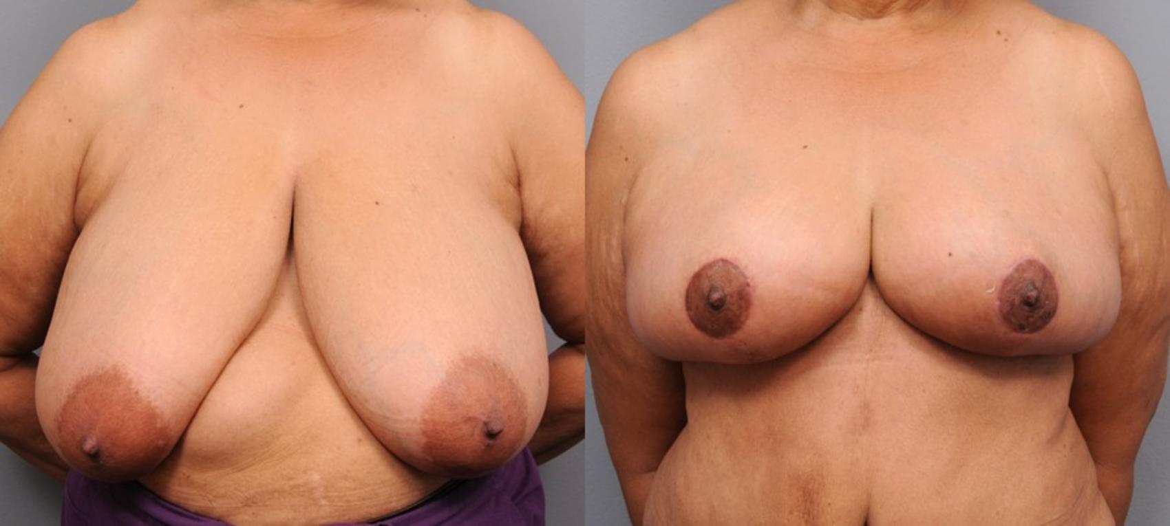 Before & After Breast Reduction Case 107 View #1 View in New York, NY