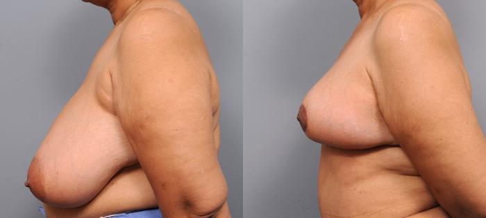 Before & After Breast Reduction Case 107 View #2 View in New York, NY