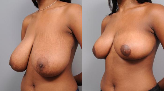 Before & After Breast Reduction Case 108 View #2 View in New York, NY