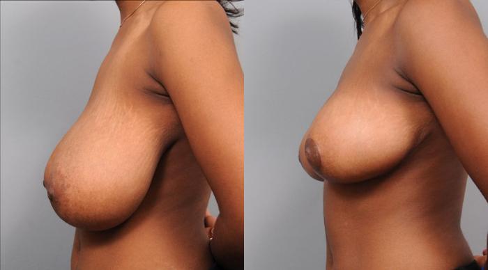 Before & After Breast Reduction Case 108 View #3 View in New York, NY